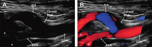 Gray scale (A) and color Doppler (B) appearance Billede af gråskala (A) og farvedoppler (B) udseende